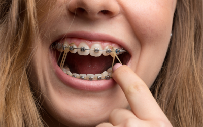 Elastics for braces, explained.