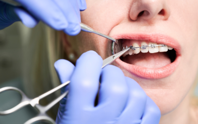 Brace Yourself for These 10 Mind-Blowing Orthodontic Facts