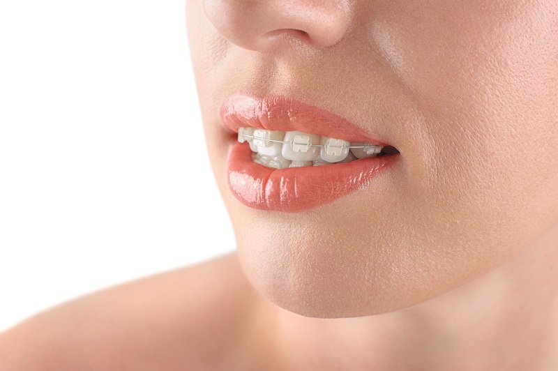 Clear Braces in Carlsbad & La Costa