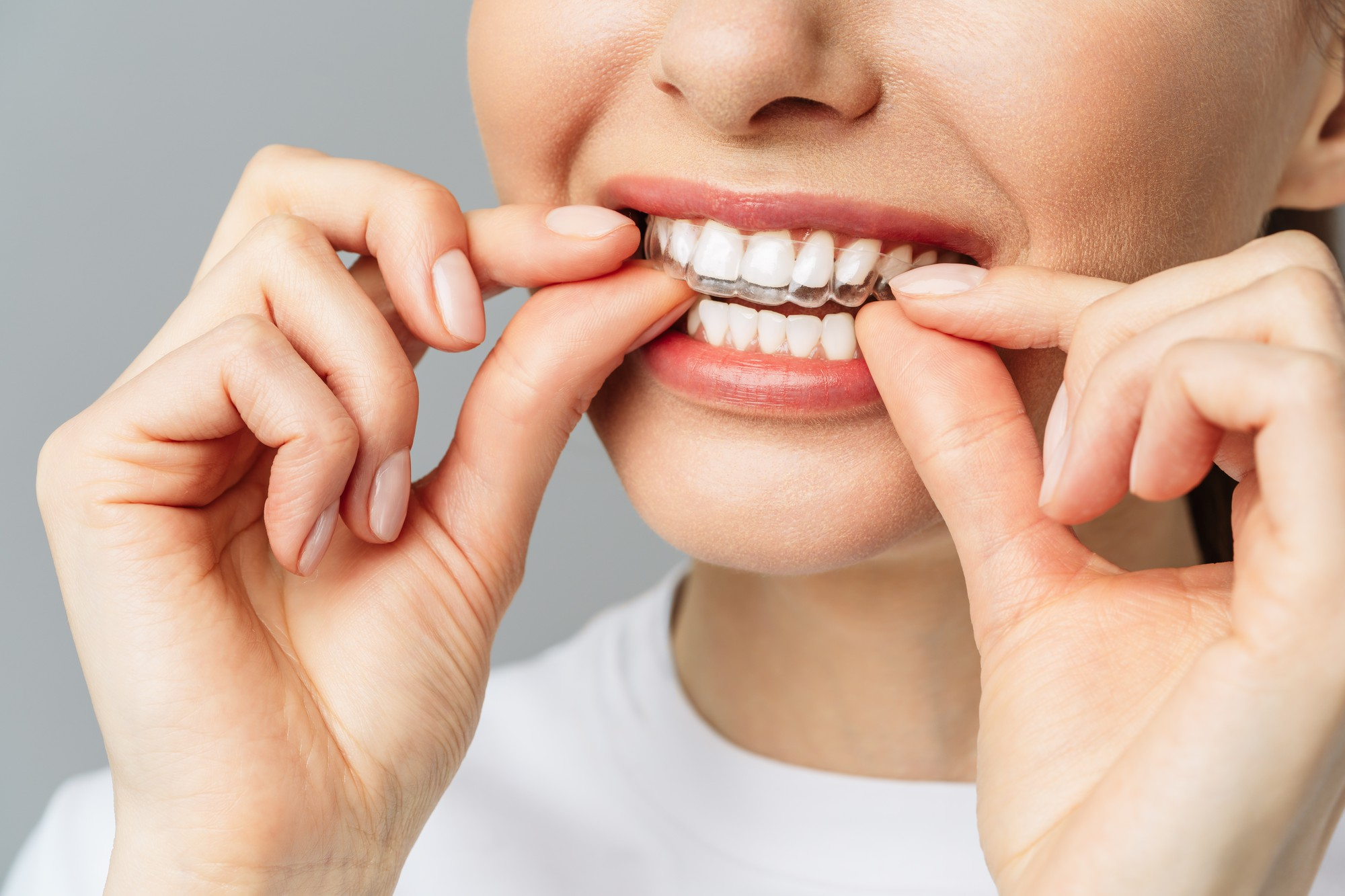 Invisalign clear aligners for teens and adults in Carlsbad CA
